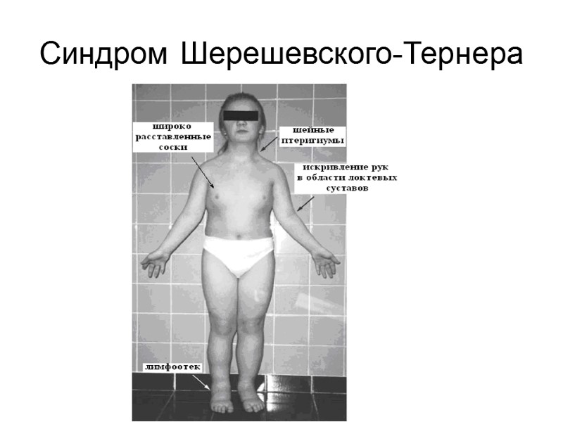 Синдром Шерешевского-Тернера